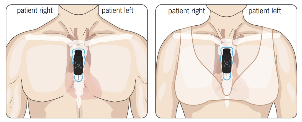 On the left, a man's torso with a black box placed vertically in the center of his chest; on the right, a picture of a woman's torso with a black box placed vertically between her breasts. On the left, a man's torso with a black box placed vertically in the center of his chest; on the right, a picture of a woman's torso with a black box placed vertically between her breasts.