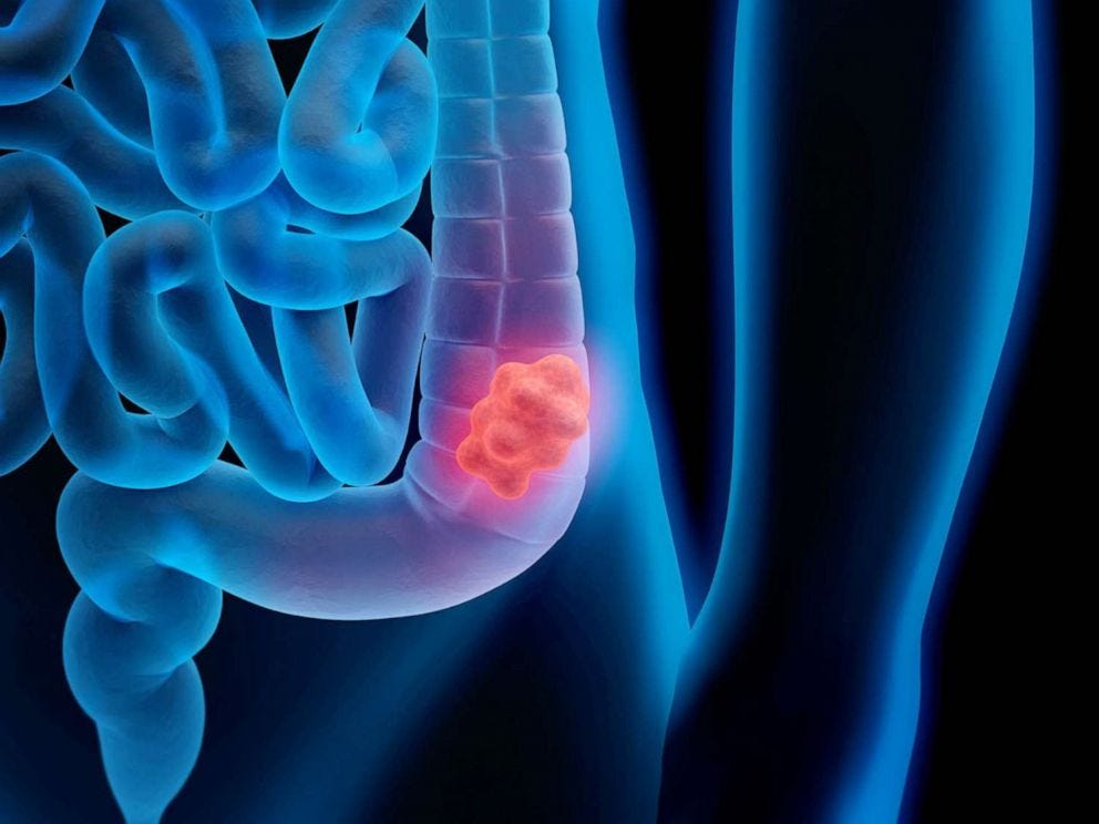 https://s.abcnews.com/images/Health/health-colon-cancer-colonoscopy-young-02-gty-llr-210126_1643239897808_hpMain_4x3_992.jpg