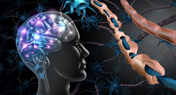 Multiple sclerosis spotlight: Early diagnosis, better treatments, and hope  for MS-free future | Back and Spine | Brain | UT Southwestern Medical Center