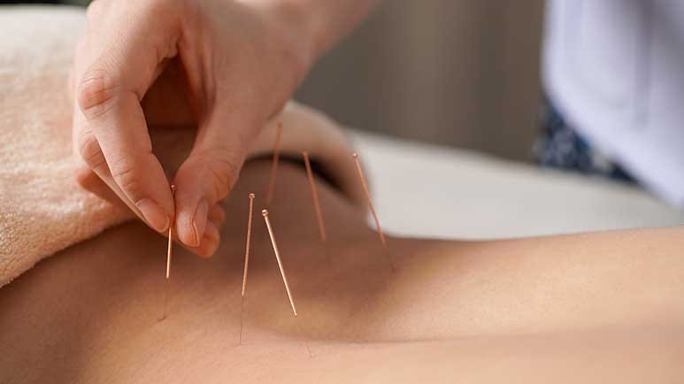 acupuncture for chronic low back pain