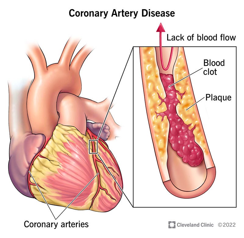 Coronary Artery Disease (CAD): Symptoms & Treatment Coronary Artery Disease (CAD): Symptoms & Treatment
