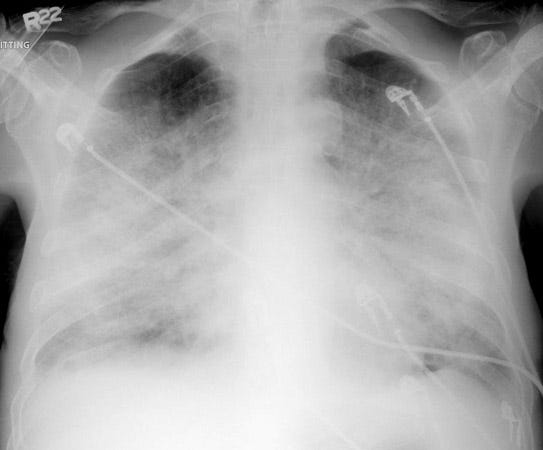 CXR pulmonary edema – Critical Care Provider