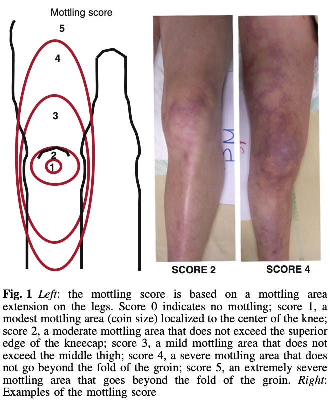 [Sepse e Choque] Mottling Score: quando a pele revela mais do que o ...