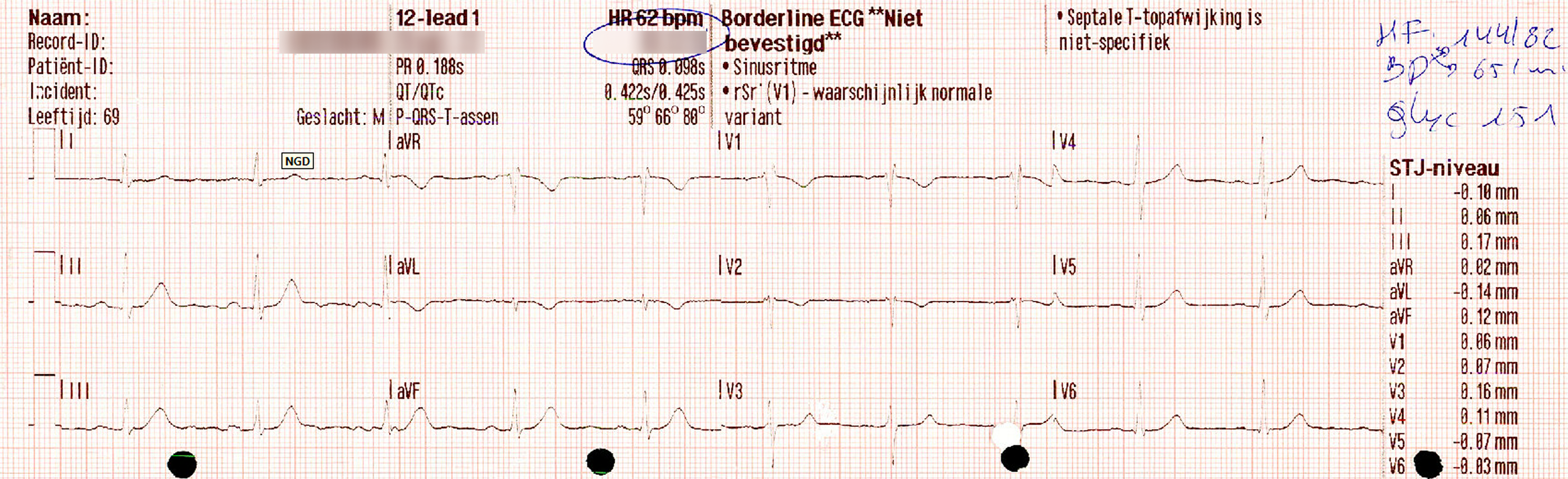 Stemi Lead Patterns Subtle STEMI: The Hidden Threat of Posterior Leads
