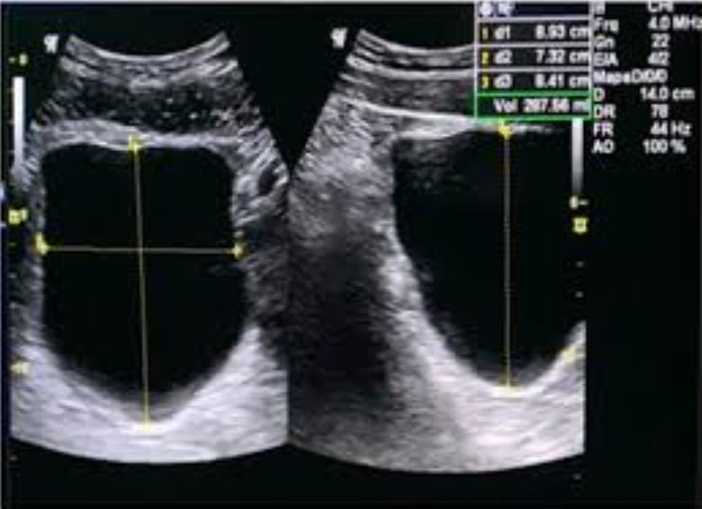 [POCUS] Qual importância do POCUS vesical em crianças?