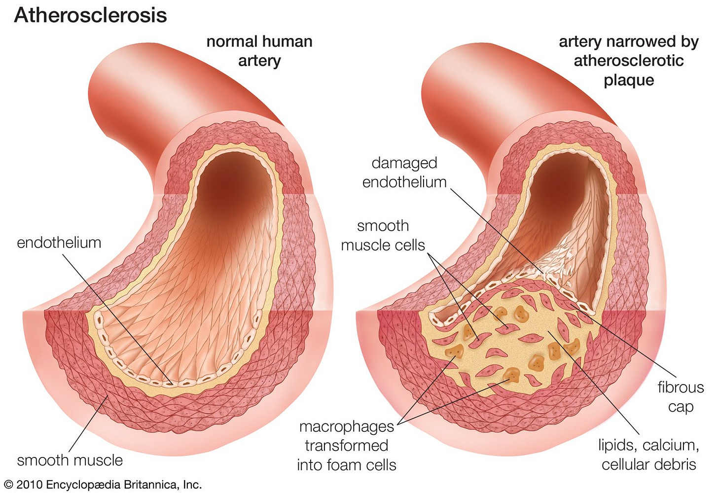 Cardiovascular disease - Diseases of the arteries | Britannica