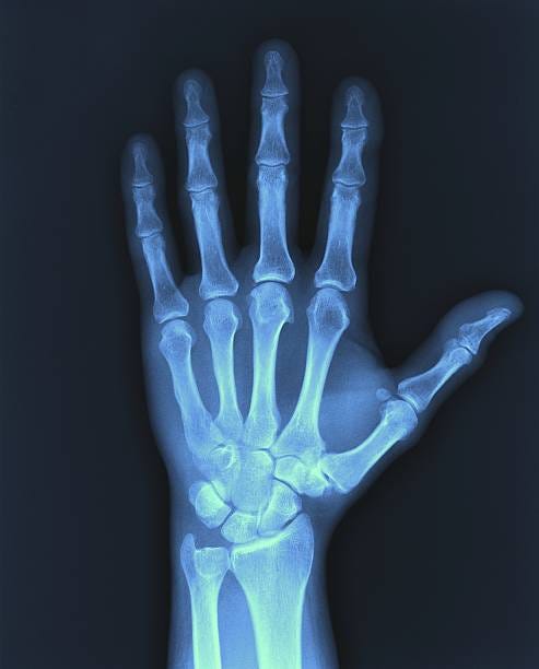 16,400+ X Ray Hand Stock Photos, Pictures & Royalty-Free Images - iStock |  X ray mouse, Ultrasound, Skeleton hand