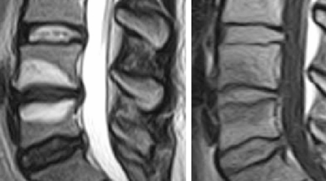 Do Modic Type 1 Changes Help Identify an “Inflammatory” Subgroup in ...
