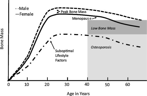 How to manage osteoporosis before the age of 50 - ScienceDirect
