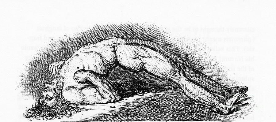 Opisthotonos by Science Source