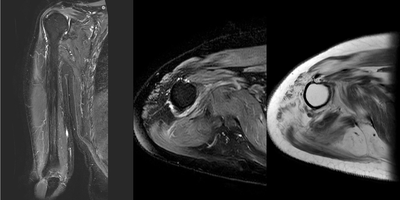 Case 61: Dermatomyositis and the Myositis Protocol MRI