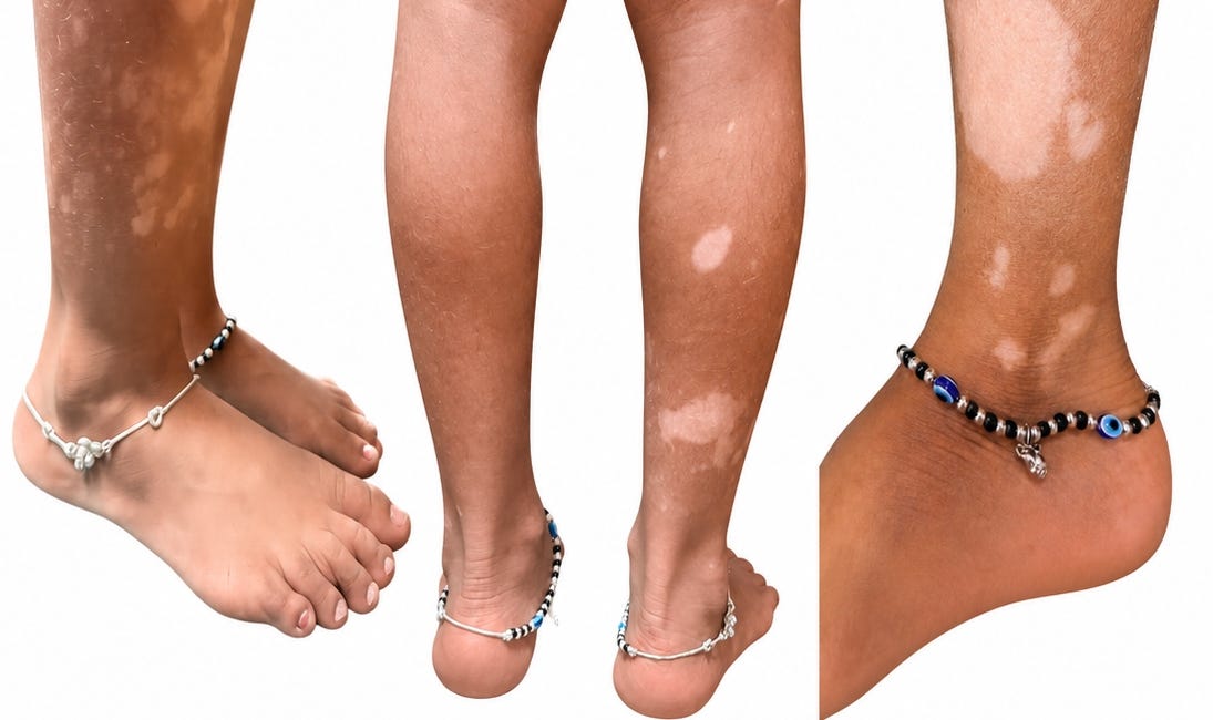 She Needed Treatment for Vitiligo. The Hospital Gave Her Vitamin C.