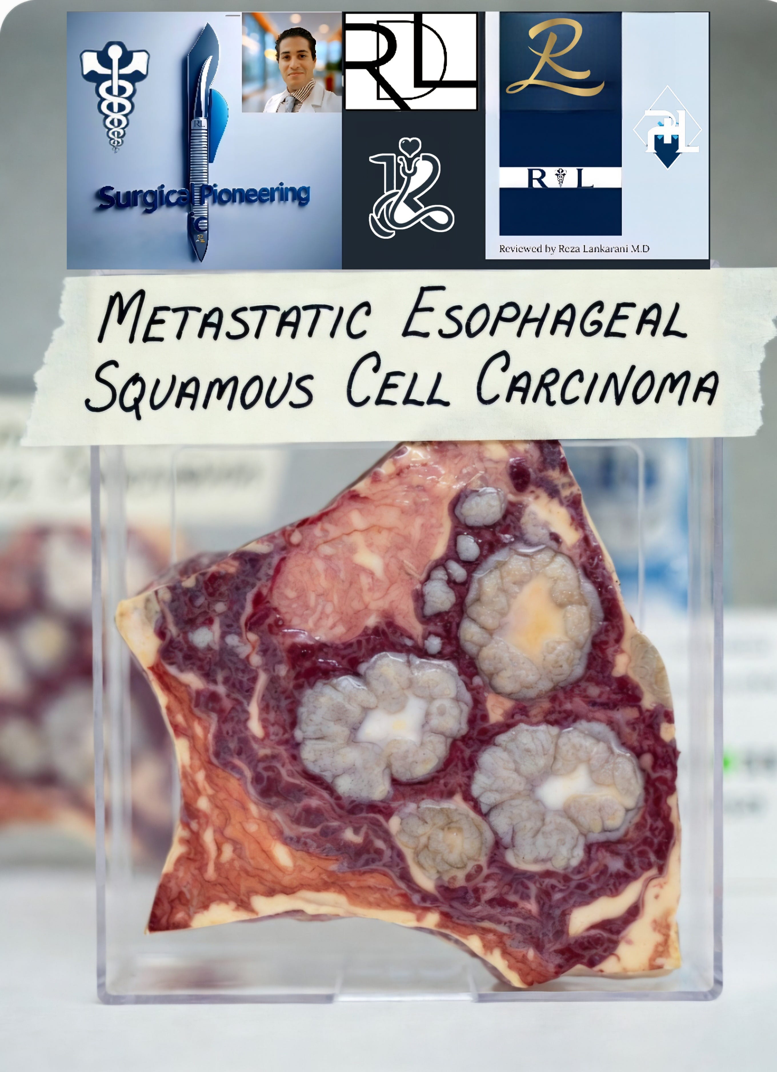 Metastatic Esophageal Squamous Cell Carcinoma Remarkable Response to ...