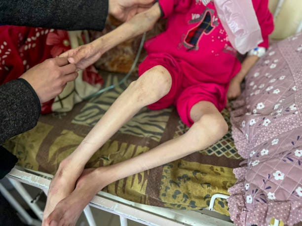 Year-old Palestinian girl Nur al-Huda Mohammed is being treated for malnutrition and severe dehydration at Kamal Adwan Hospital while there is a...