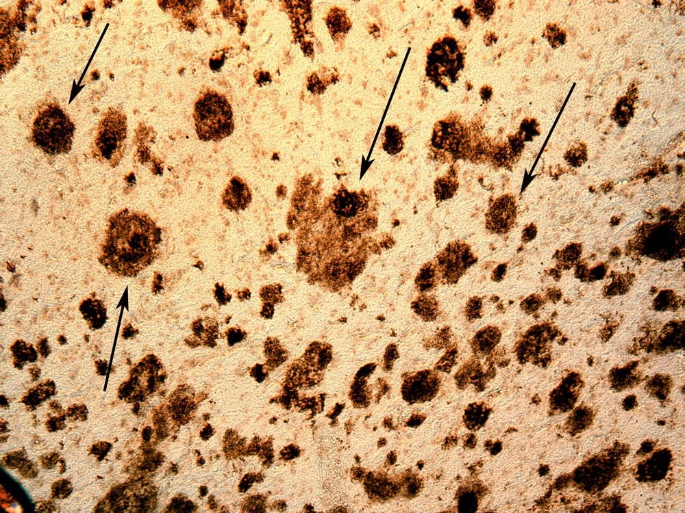 Studying Down syndrome might help us understand Alzheimer's disease better