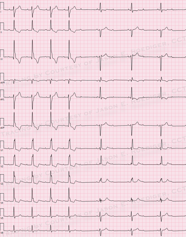 12-lead ECG showing trifascicular disease: alternating RBBB with LPFB and RBBB with LAFB, plus AV block