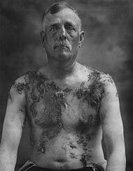 Tarring and feathering victim front. Tarring and feathering victim front.