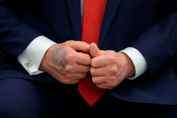 A bruise is visible on the back of Trump's right hand during a meeting with South Korean President Lee Jae-myung on Aug. 25.