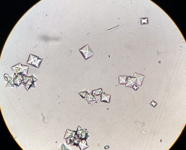 Figure, Microscopic view of calcium oxalate...] - StatPearls - NCBI  Bookshelf