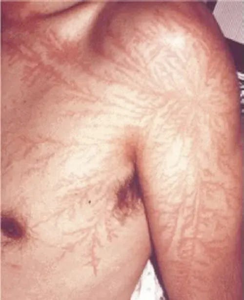 https://twistedsifter.com/2012/03/lichtenberg-figures-lightning-strike-scars/