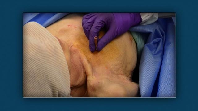 pic of a needle decompressing a chest