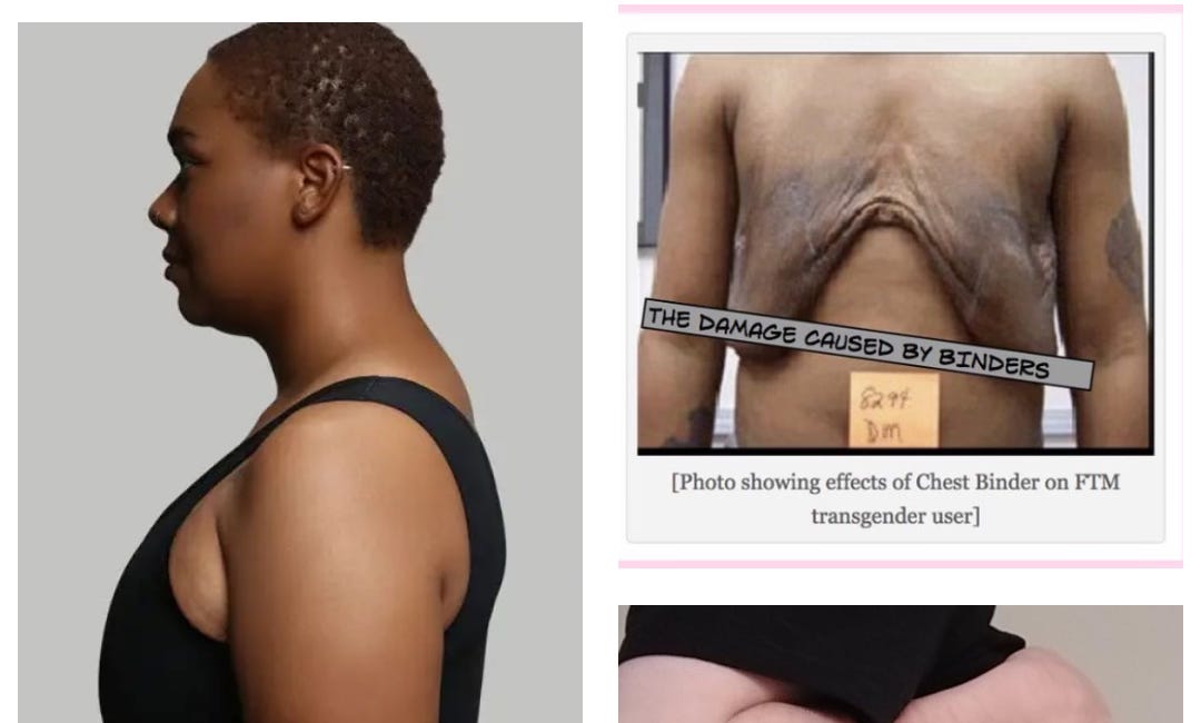 Breast Binding is a Medical Transition Intervention.