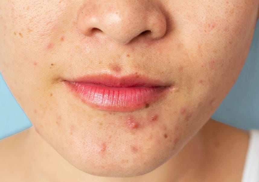 A woman presenting with period acne