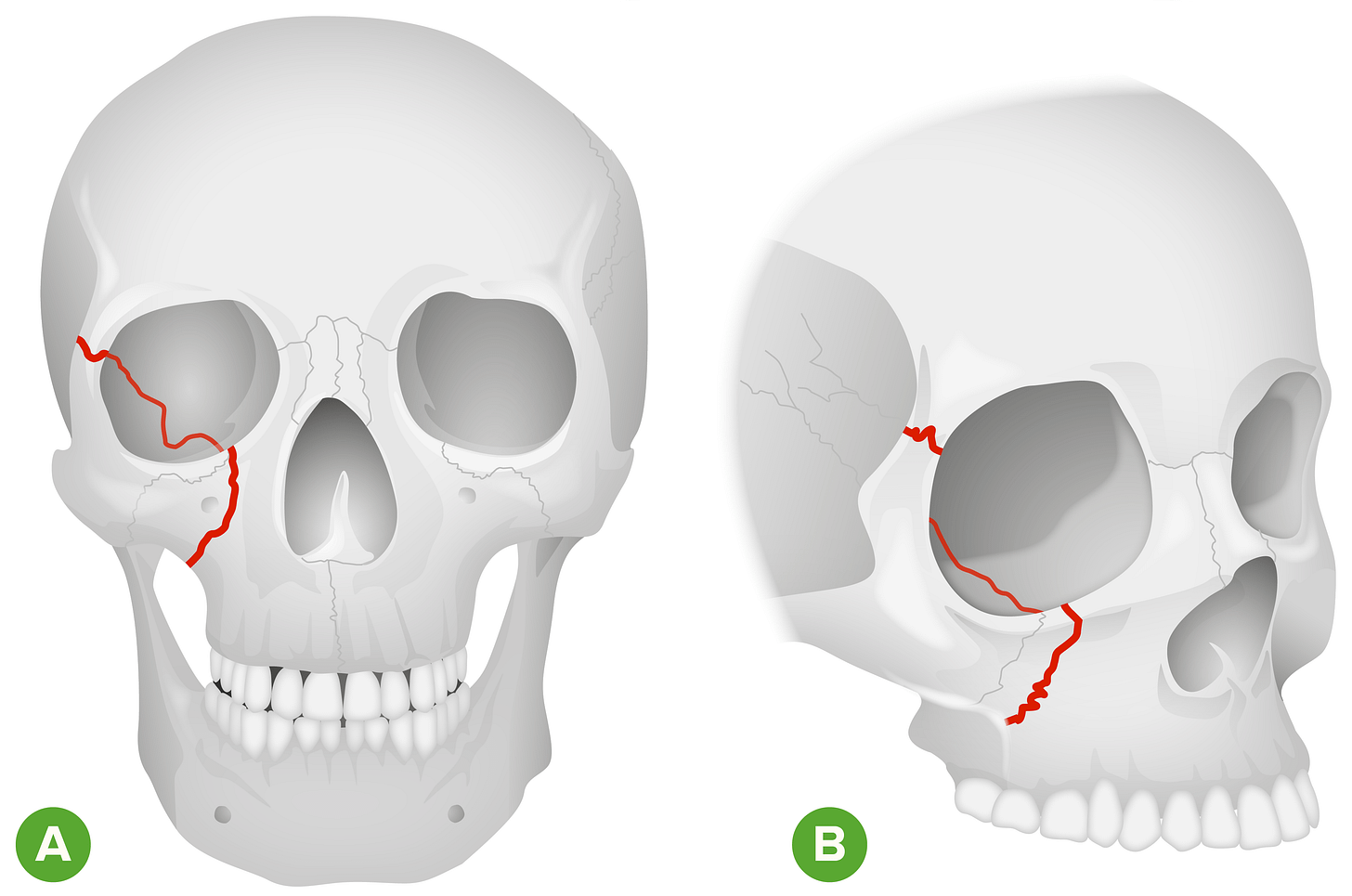 Fracturas Orbitales | Concise Medical Knowledge