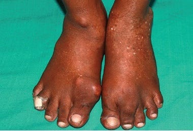 Gout Tophi Bump On Top Of Foot: Causes, Symptoms & Treatment Gout Tophi Bump On Top Of Foot: Causes, Symptoms & Treatment