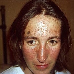 Lupus