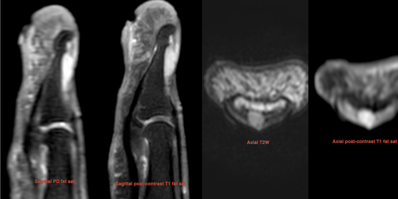 Case 53: A Throbbing Finger