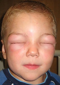 Angioedema - Wikipedia Angioedema - Wikipedia