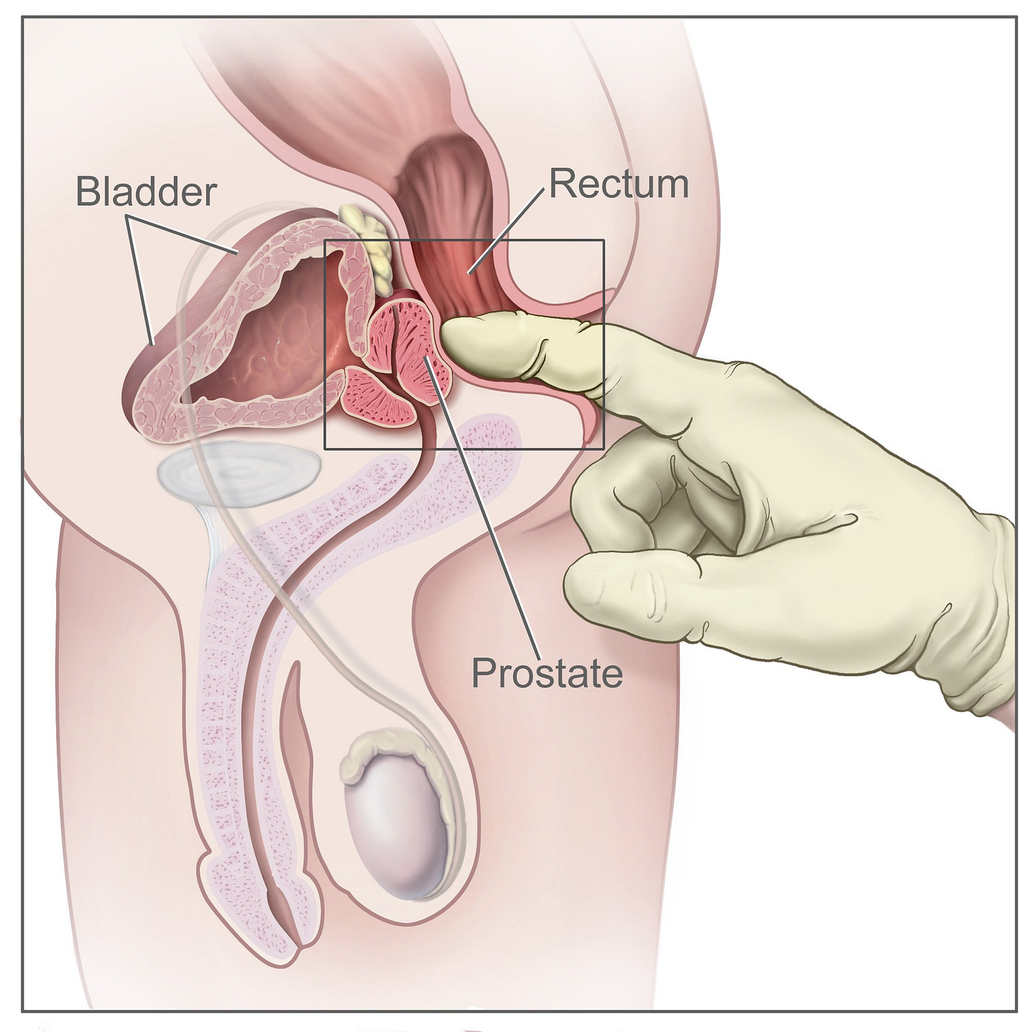 Finger of gloved hand presses against prostate in cross-sectional view.
