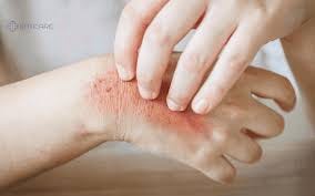 Understanding Summer Allergies: What's ...