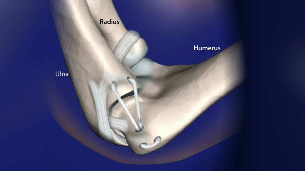 Tommy John Surgery (Ulnar Collateral Ligament Reconstruction) | Johns  Hopkins Medicine