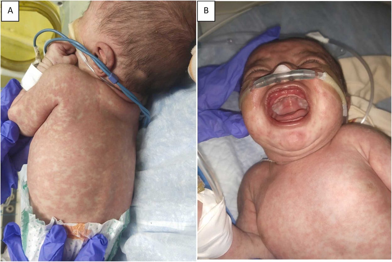 This 14 day old baby had a “severe disease course” after getting measles from his mother. 