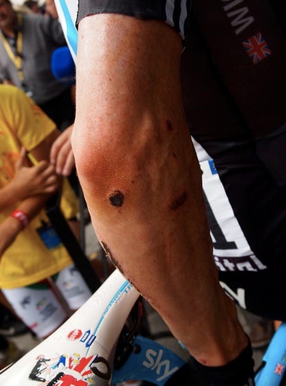 Wiggins arm