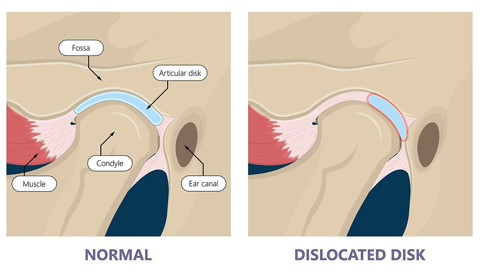 What are the Signs and Symptoms of Temporomandibular Disorders (TMDs)?