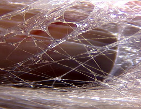 Interstitium: “Rediscovery” of the Connective Tissue System of the Body