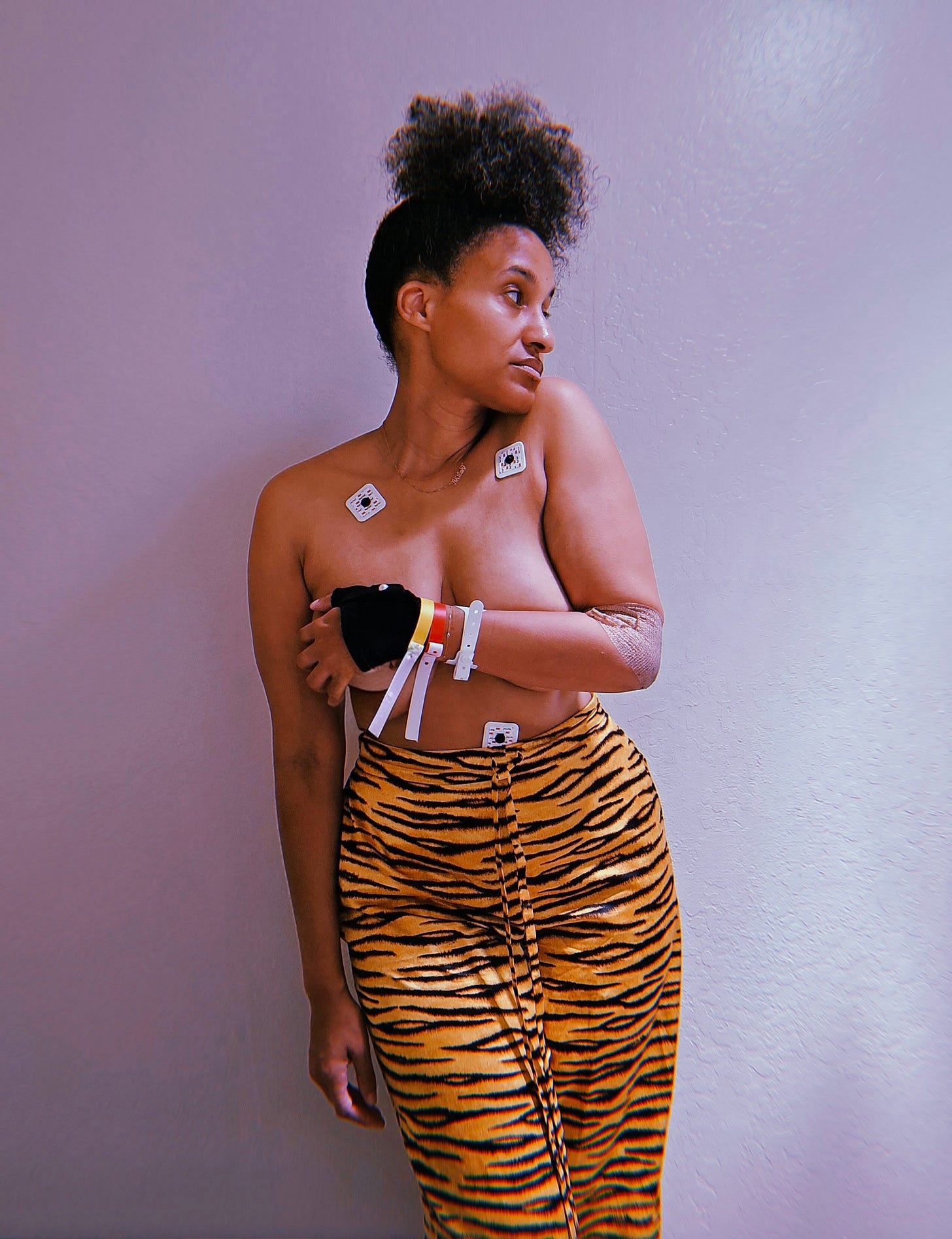 Dr. Cadet stands against a white wall topless using her braced hand and multiple hospital braces to hold her award winning cleavage. Her arm banded from the IV rests amongst leads from the monitor. Wearing the tiger pajama pants she wore to the ER )that hide her swollen stomach) she looks like a MF model as she looks to one side. Photo by Dr. Cadet.