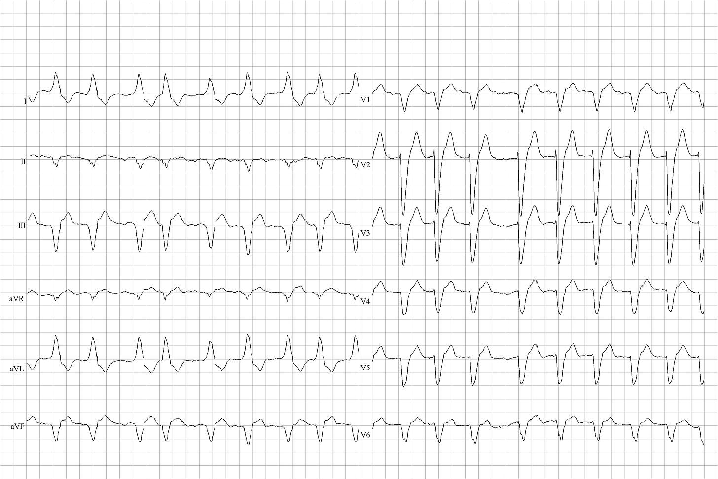 AF with rapid ventricular response (RVR), LBBB and left QRS axis deviation AF with rapid ventricular response (RVR), LBBB and left QRS axis deviation