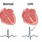 Left ventricular hypertrophy (LVH)