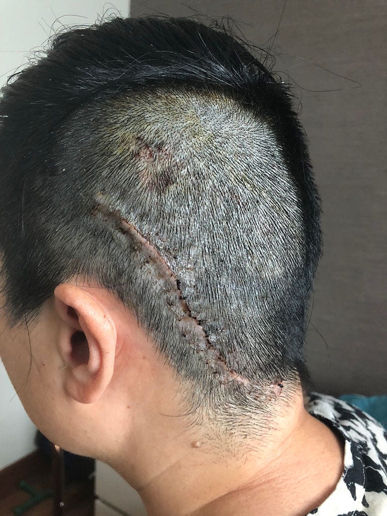 Close-up of a person's head with a shaved area showing a healing surgical scar. Close-up of a person's head with a shaved area showing a healing surgical scar.