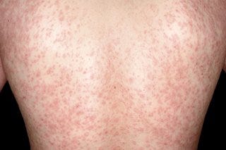 Picture of widespread red, scaly rash on the back of a person with white skin. Picture of widespread red, scaly rash on the back of a person with white skin.