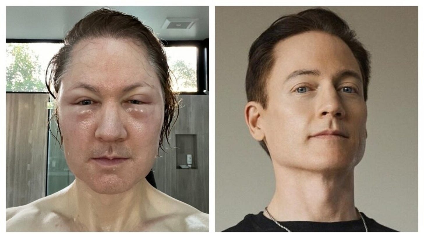 Tech millionaire Bryan Johnson's face 'blows up' after scary, botched procedure: 'Fat injections from donor' | Health - Hindustan Times Tech millionaire Bryan Johnson's face 'blows up' after scary, botched procedure: 'Fat injections from donor' | Health - Hindustan Times