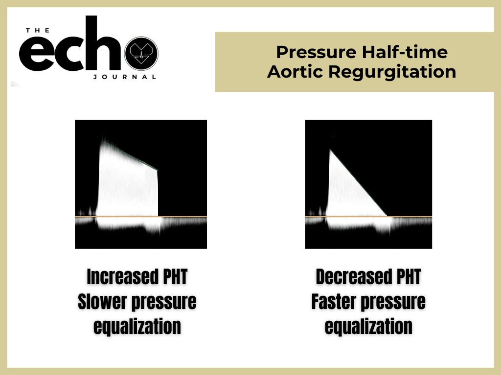 Aortic Regurgitation Pressure Half Time The Tool You Should Know About aortic-regurgitation-pressure-half-time-the-tool-you-should-know-about