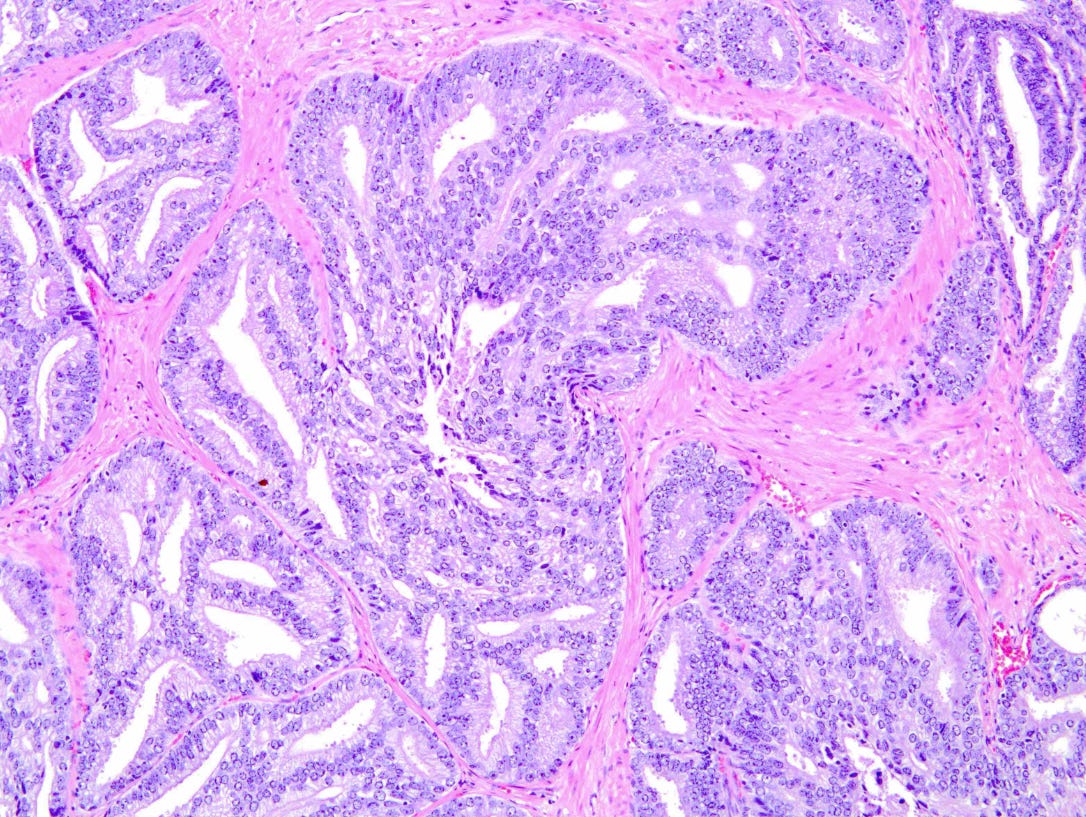 Microscope photo of white holes stuffed with tangles of cells against a pink stromal background. Microscope photo of white holes stuffed with tangles of cells against a pink stromal background.