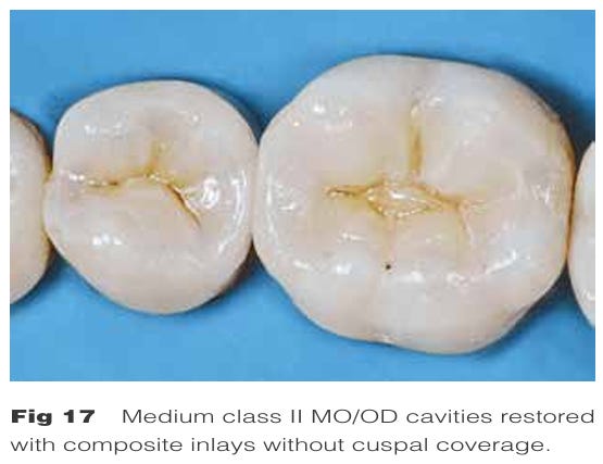 Post Indirect Kit Posterior indirect adhesive restorations: updated indications and the ...