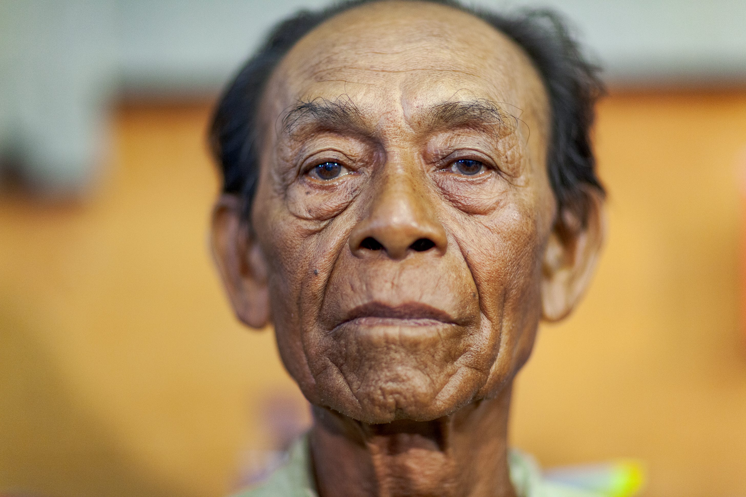 A patient awaiting cataract removal in a mobile eye clinic A patient awaiting cataract removal in a mobile eye clinic