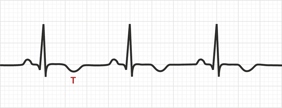 T Wave Inversion | Test Findings - MedSchool